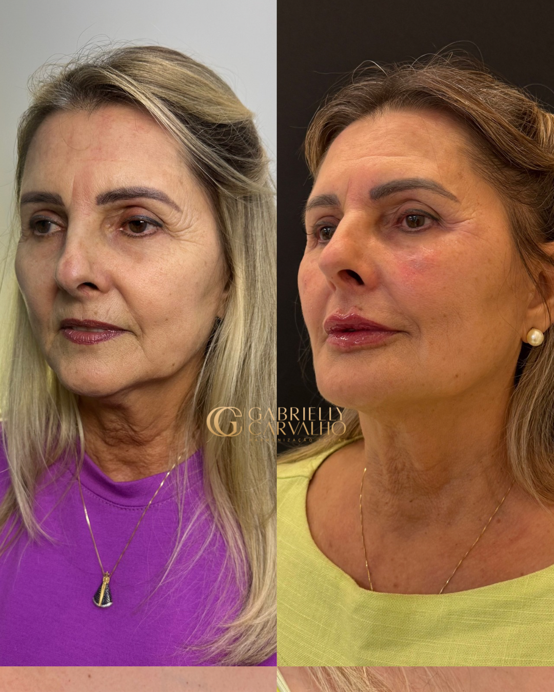 Resultado — Harmonização Facial
