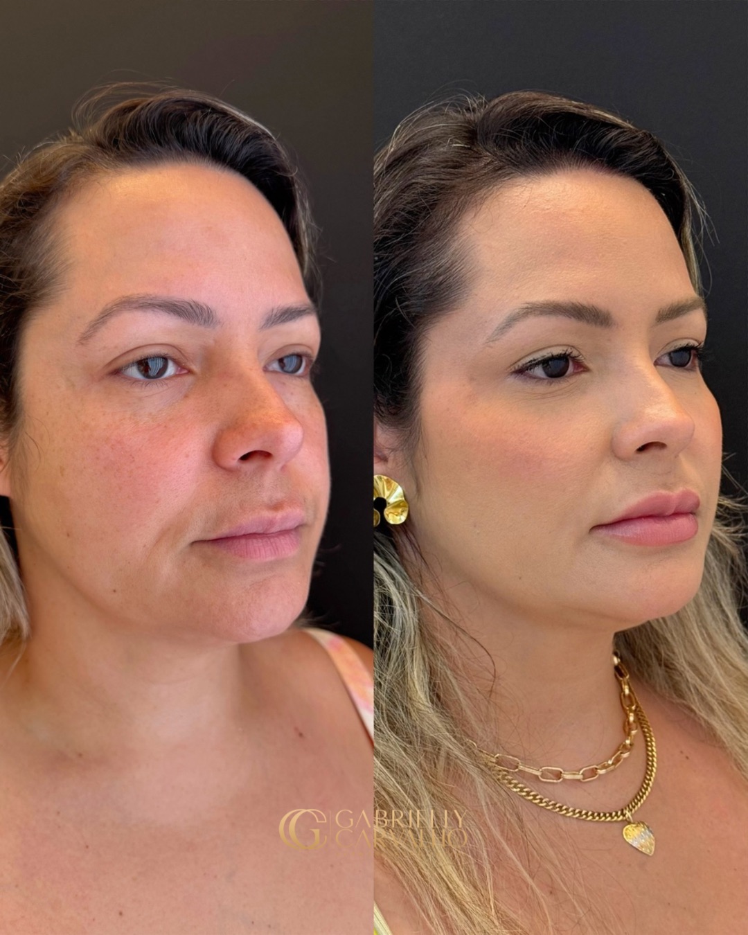 Resultado — Harmonização Facial