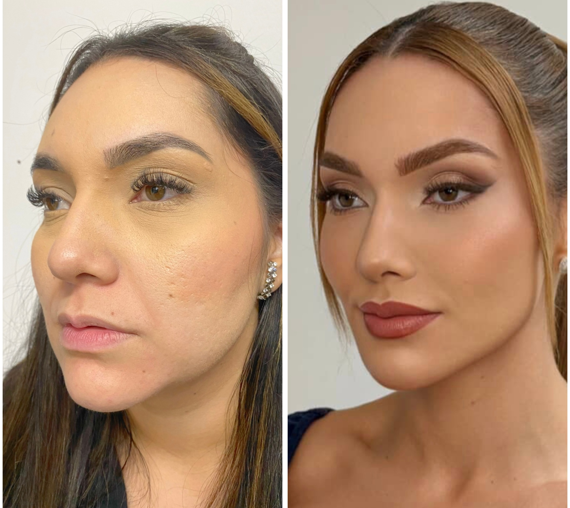 Resultado — Rejuvenescimento Facial