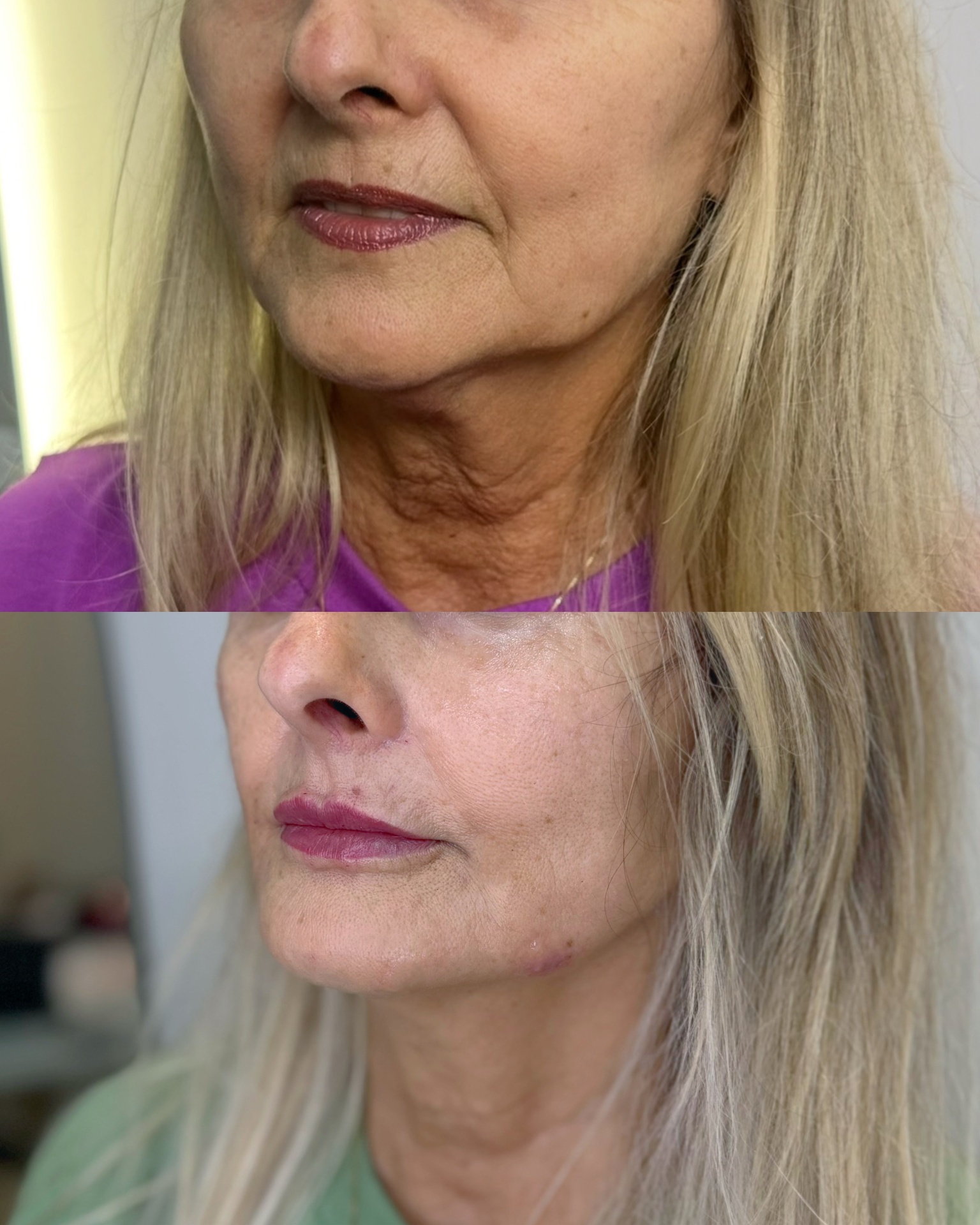 Resultado — Preenchimento Labial