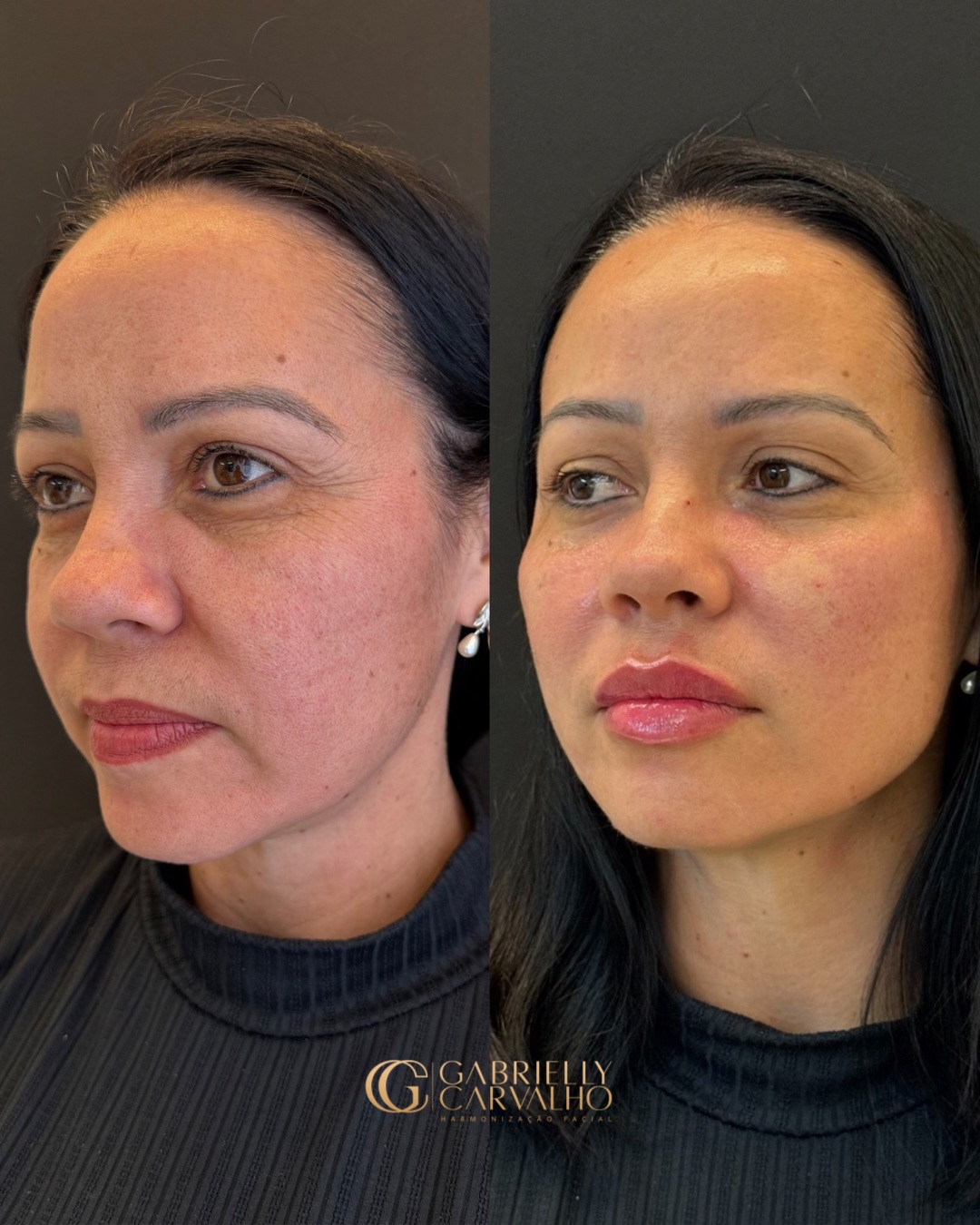 Resultado — Rejuvenescimento Facial