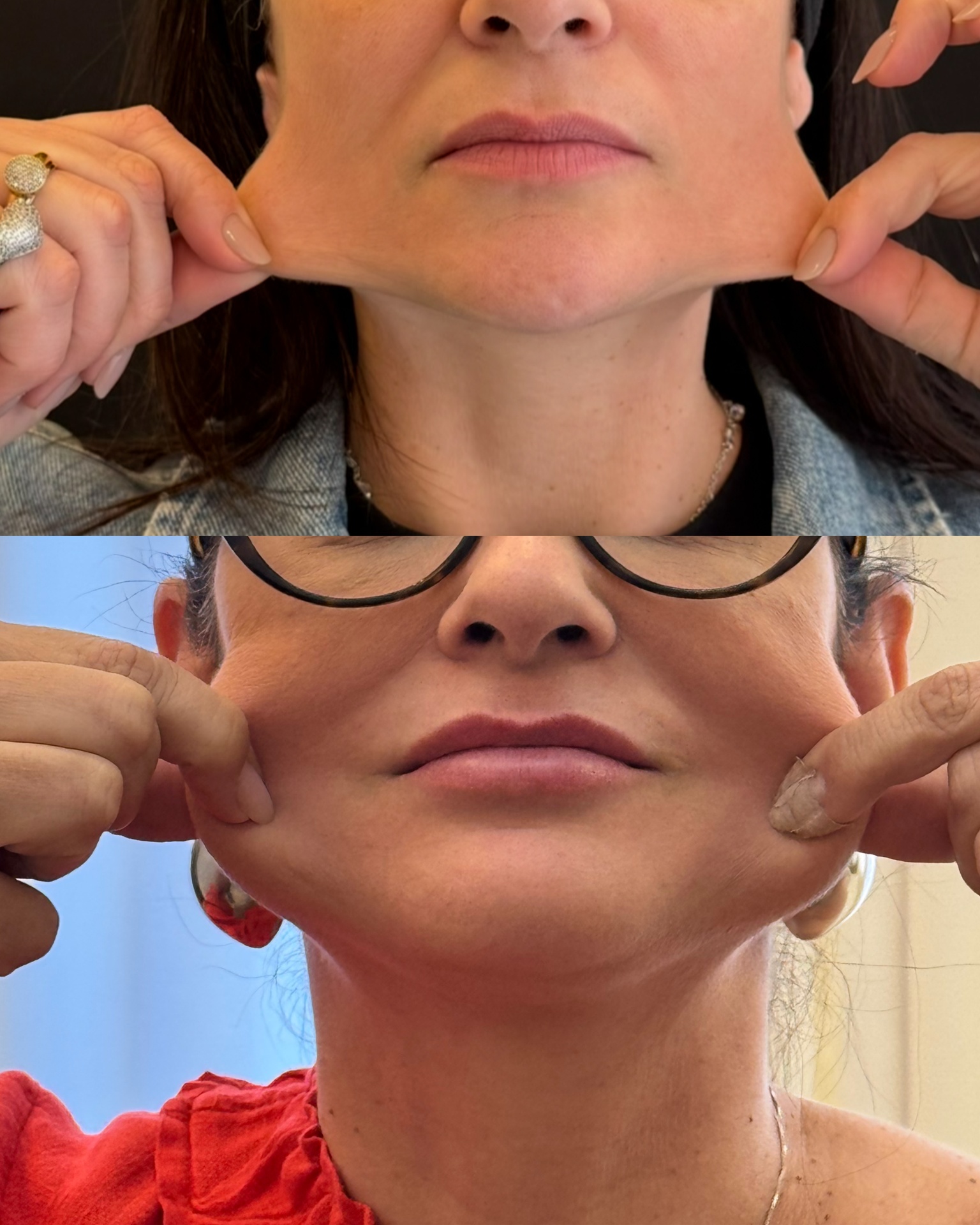 Resultado — Contorno Mandibular