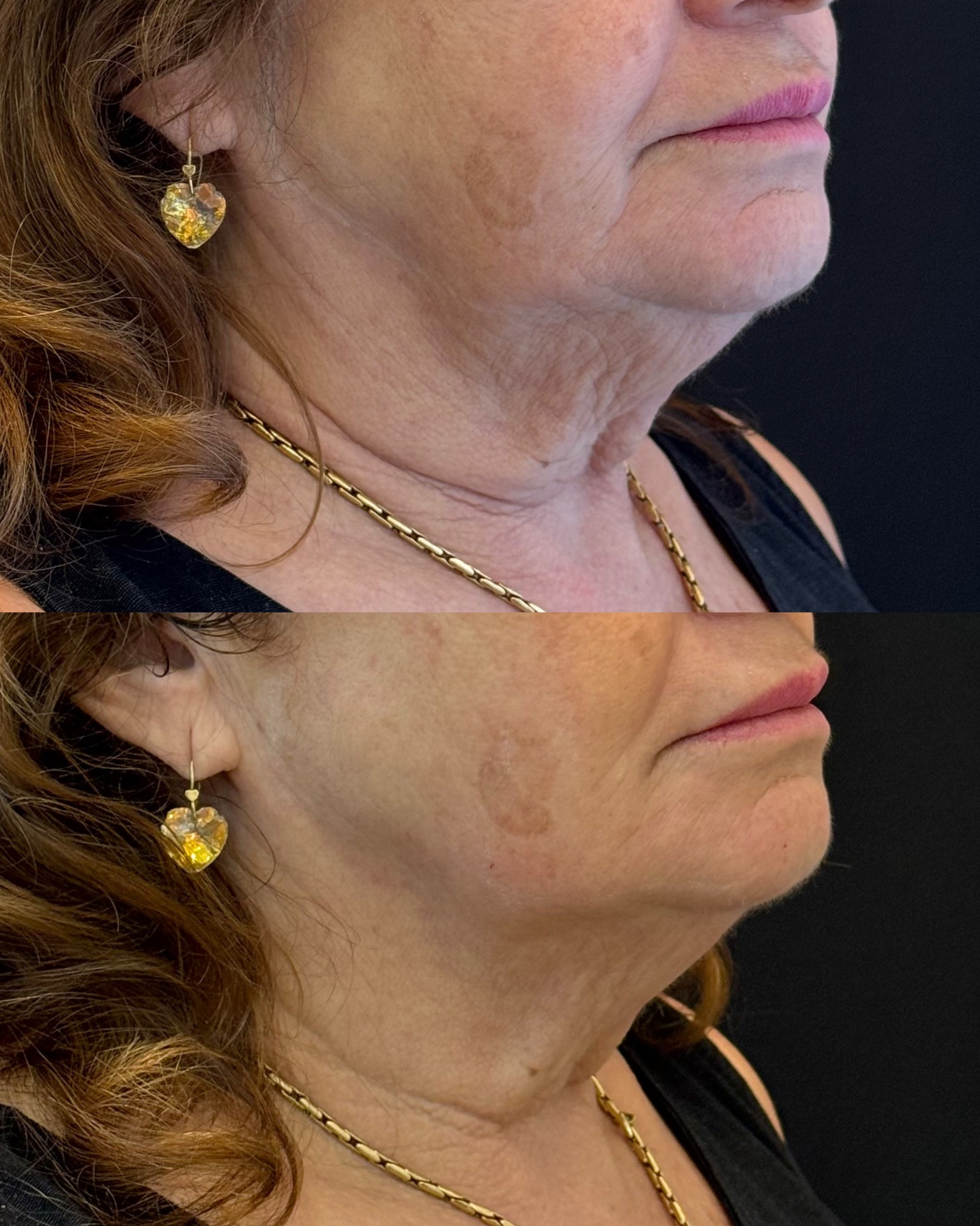 Resultado — Lifting de Pescoço
