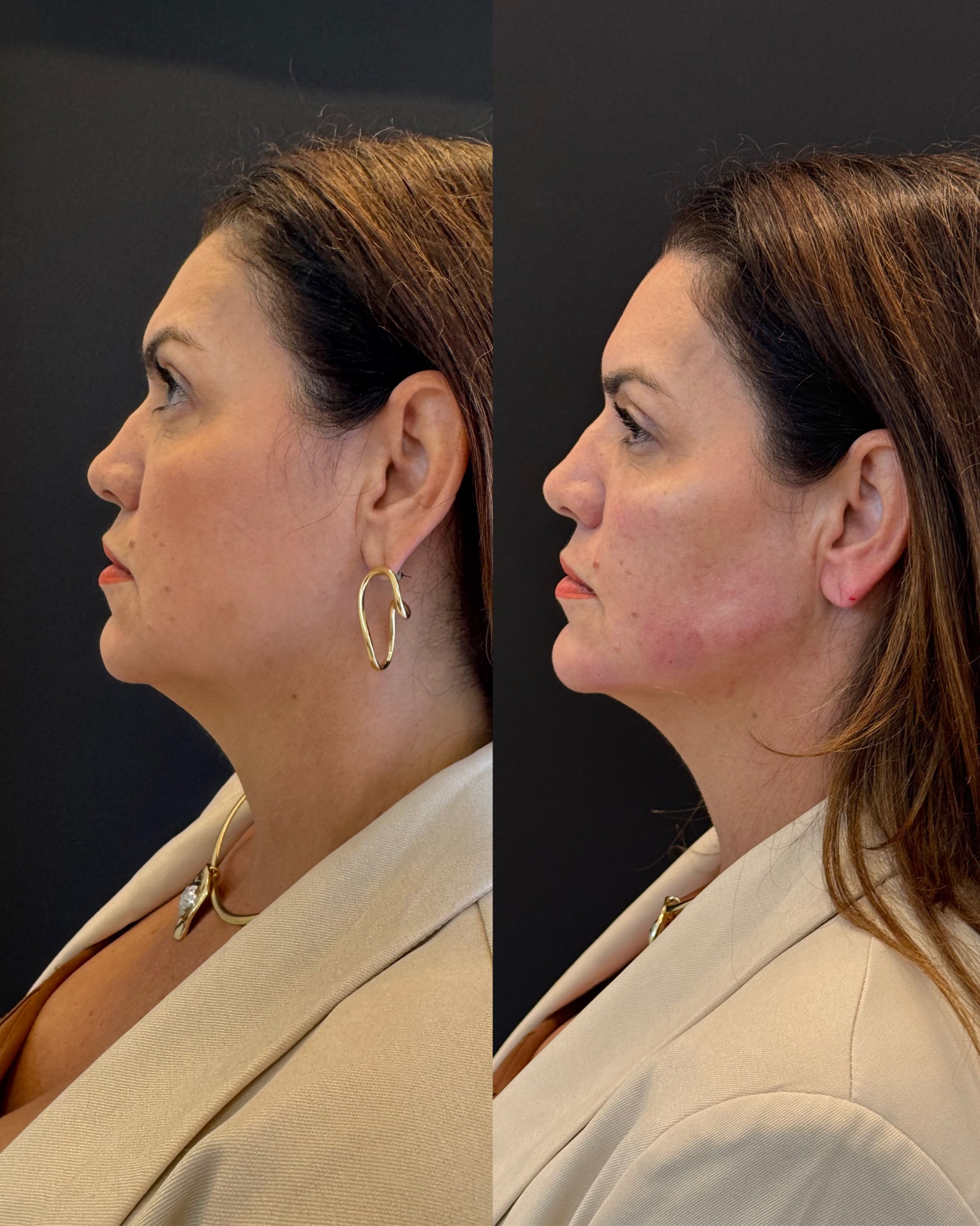 Resultado — Bichectomia / Definição Mandibular